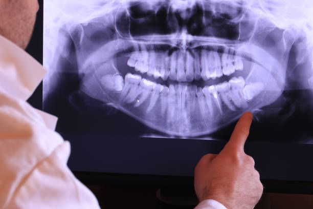 Best Emergency Wisdom Tooth Extraction in Gunnison, UT